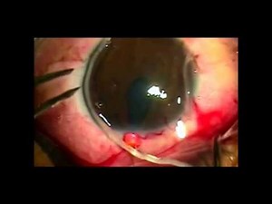 Man with Parasite Worm in Eye - Nematode Worms in Eyeball