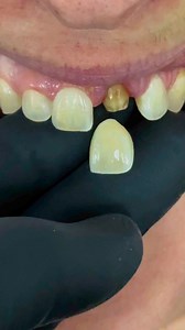 286K views · 352 reactions | Overcoming dark tooth color prep! | Luke Kahng | Facebook