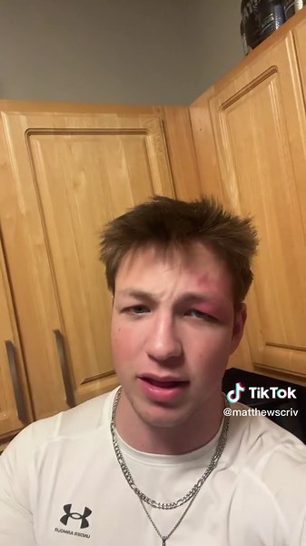 Understanding Port Wine Stains and Their Treatment