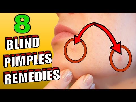 How To Get Rid Of A Blind Pimples (HOME REMEDIES)