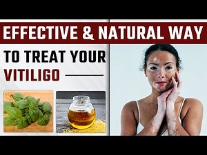 How to Prevent Vitiligo from Spreading | Follow these Tips to Treat Vitiligo Naturally | Dr. Health