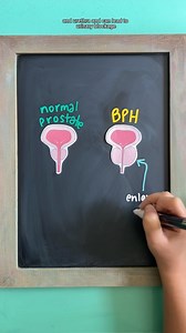 BENIGN PROSTATIC HYPERPLASIA (BPH) NCLEX Review follow @nursewellversed for visual nursing education BPH is a non-cancerous enlargement of the prostate gland, causing pressure on the bladder and urethra, which can lead to urinary blockage. Risk Factors: ➡️ Males over age 50 ➡️ Family history ➡️ Sedentary lifestyle ➡️Smoking ➡️ Hormonal imbalances (increased estrogen & DHT) Symptoms (due to partial urine blockage): → Weak urine stream → Urinary frequency & urgency → Incomplete bladder emptying → 
