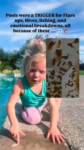 1.6K views | Parasites were causing eczema, allergic reactions,...