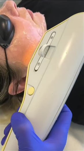 Tratament laser IPL #lumenis #exilite alături de echipa Dermisana! | Clinica Dermisana