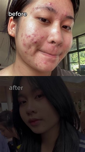 อึ้งเลย 👀 #beforeafter #ดูแลตัวเอง #สกินแคร์ #หน้าใส