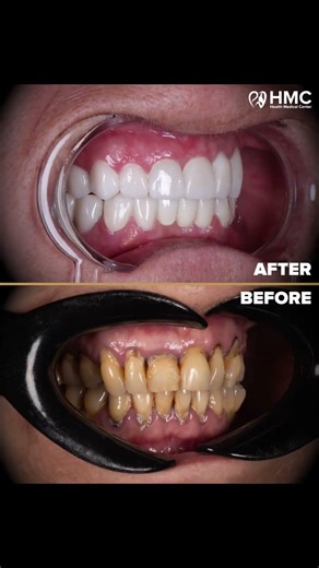 The Power Combo for a Perfect Smile | Implants & Zirconia Crowns
