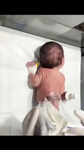 44K views · 969 reactions | In this video, we’re showing step-by-step MMC (Myelomeningocele) wound covering and dressing tips for newborn care in the NICU.  Proper wound care is essential to prevent infection and promote healing.  Watch till the end to see how gentle handling and sterile technique make all the difference.  #NICUCare #MMCWoundCare #NeonatalNursing #BabyHealth #NICUHeroes #MedicalEducation #NurseLife #ViralVideo #HealthTips | pediatrician019 | Facebook