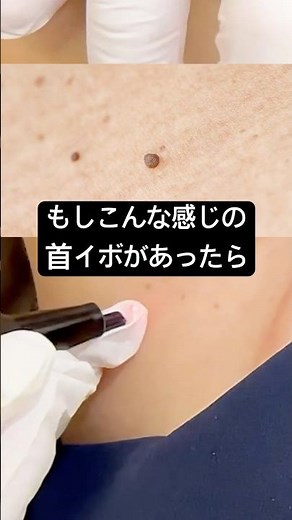 【ビフォーアフター】首イボを簡単に取る方法