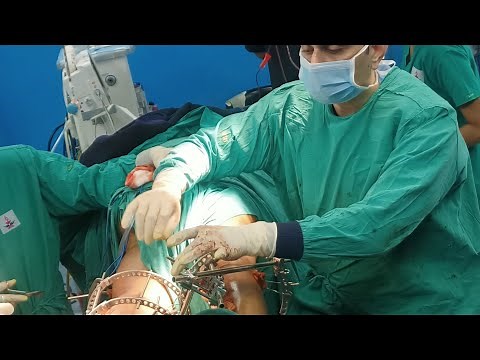 compound comminuted tibia fracture managed with Ilizarov frame - case report