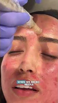 What is Micro-needling?