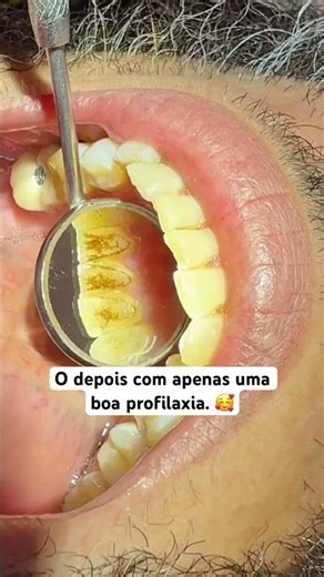 Uma boa profilaxia pode mudar o seu sorriso. #dentistaemsalvador #periodontia