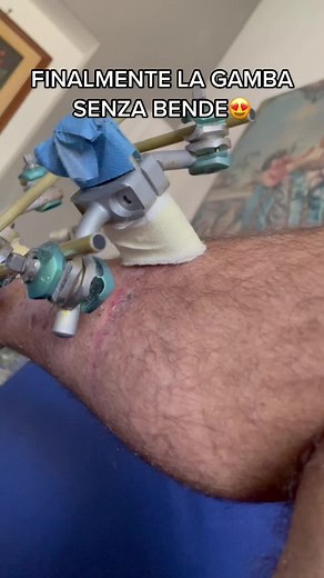 Understanding External Fixation Systems in Medicine