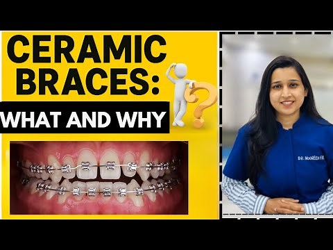 😬 Ceramic Braces Explained: What, Why & How!