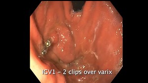 Annotated step-by-step annotated demonstration of EUS-guided coil-glue treatment