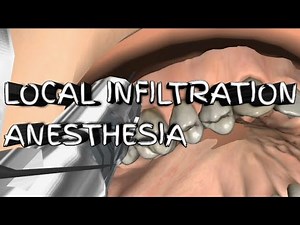Local Infiltration Anesthesia||Technique