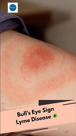 Bull’s Eye Sign || Lyme’s Disease || 220 || Dr Medica Clinical Cases || Education || Diagnosis ||