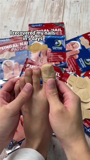 Transform Ugly Toenails: Antifungal Patches Overnight