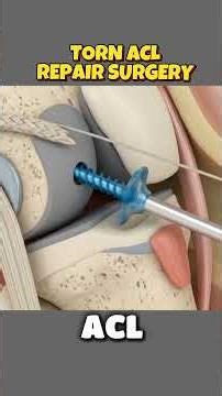 ACL Reconstruction Surgery | How a Torn ACL Is Rebuilt? (3D Animation)#tornaclsurgery#aclreconstruct