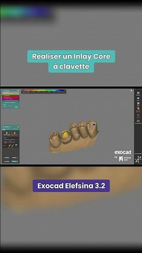 Exocad : Inlay Core à CLAVETTE !! 😱 #shorts #dental #exocad #cadcam #dentistry #dentist #dentaltips