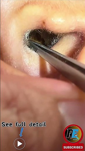 Interesting Earwax ASMR | The Most Satisfying Ear Cleaning for Massive Ear Blockages