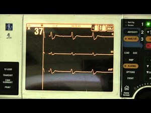 Third Degree Heart Block, Complete Block