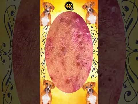 Blackheads Removal | Acne Treatment and Very Satisfying Satisfying Pimple pop #blackheads