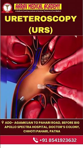 Ureteroscopy (URS) | How Doctors Remove Kidney Stone Without Surgery | #URS #KidneyStone #shorts