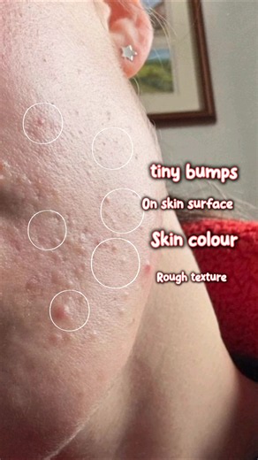 Routine for comedones and clogged pores for sensitive- combination skintype #pores #comedones #skin