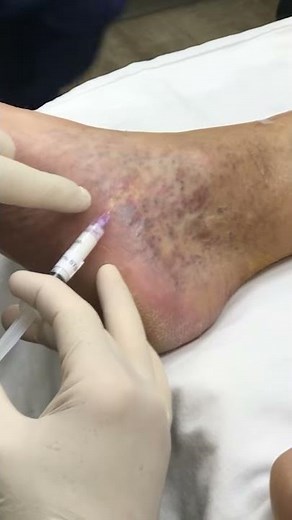 Dr. Haney injects sclerotherapy - treatment for SPIDER VEINS