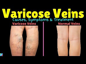 Varicose Veins – Causes, Symptoms, Pathophysiology, Diagnosis, Treatment