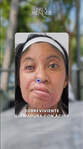 Quemaduras con Ácido