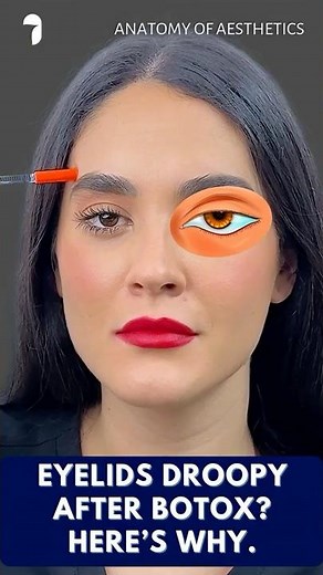 Part One - Droopy Eyelid After Botox? Here's What Happened | Anatomy of Aesthetics