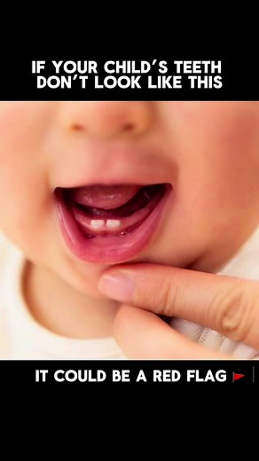Understanding Baby Teeth Gaps for Healthy Development
