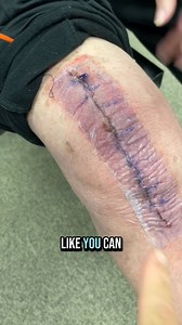 164K views · 434 reactions |  What to Expect 2 Weeks After Total...