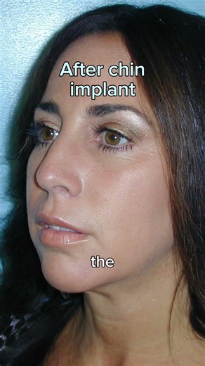 Chin Implant Before and After and Patient Testimonial - Dr. Janjua