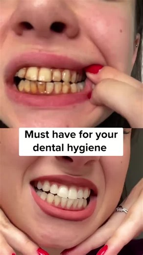 Smile Therapy Ultrasonic Tooth Cleaner Review