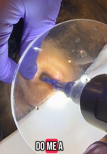 Ear Wax Removal Irrigation Procedure | Audiologist Demo