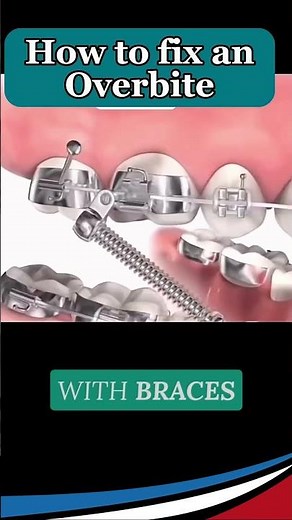 How to fix an overbite with Braces