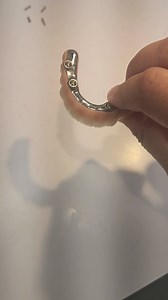 36 reactions · 6 comments | PMMA all-on-x hybrid with titanium iBar. Hygienic pontic design | Artisan-Lab-USA | Facebook