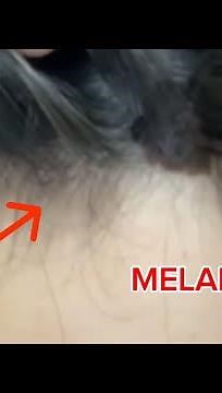 What is Melanoma? Alondra Sierra Spreading Awareness on Melanoma/Skin Cancer ☀️