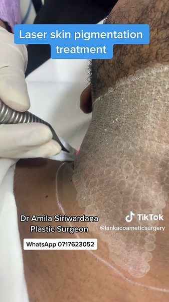 Laser treatment for Acanthosis Nigricans…#dermatologist #acanthosisnigricans #skin #pigmentation #dramilasiriwardana #skinlaser #plastucsurgery #viral #srilankatiktok #fyp @lushskinclinic