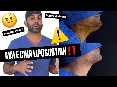 MALE CHIN LIPO (risks, cons & recovery tips for men)