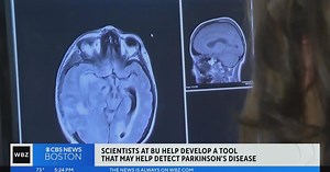 Artificial intelligence could help detect Parkinson's disease, BU study finds