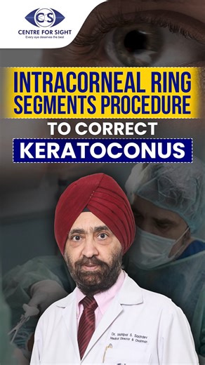 2.1K views | ICRS Procedure for Keratoconus Explained by Dr. Mahipal S. Sachdev Struggling with keratoconus? ️ Dr. Mahipal S. Sachdev, Chairman & Medical Director at Centre For Sight, explains how Intracorneal Ring Segments (ICRS) help reshape the cornea, improve vision, and delay the need for corneal transplant. #Keratoconus #ICRS #DrMahipalSachdev #CentreForSight #CornealTreatment #EyeCare #VisionCorrection #IntracornealRings #Ophthalmology | Centre For Sight | Facebook