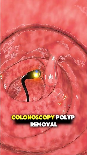 Colonoscopy Polyp Removal (3D Animation)#3danimation #medicaleducation #healthcare #fyp