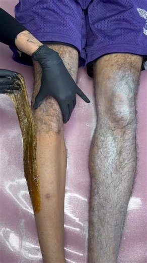 Sweet & True Sugaring on Instagram: "Sugaring LOVES coarse hair. Plus with maintenance appts, it can lead to finer regrowth! 💞 With natural ingredients of sugar, water & lemon, sugaring is gentle on the skin but tough on hair removal Sugarist: @serena_thesugarista #sweetandtruesugaring #sugaringhairremoval #esthetician #sugaring #bodysugaring #sugaringwax #sugarist #estheticianlife #estheticianstudent #sugarwax"