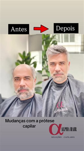 Transformação Incrível com Prótese Capilar