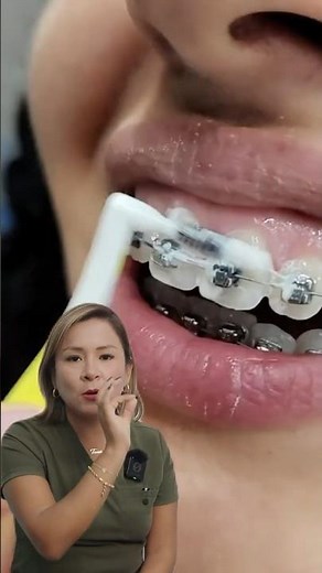 Cómo limpiar tus brackets correctamente 🦷✨ #Ortodoncia