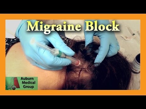 Migraine Cure Nerve Block | Auburn Medical Group