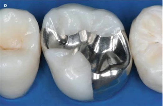Advantages of amalgam restoration It has a high compressive strength. It is used for patients with high Caries index. - It is used for small and large cavities. - It is durable and can last for years. -It is cheaper than composite. -High copper amalgam is better than the traditional amalgam. #amalgam #corrosion